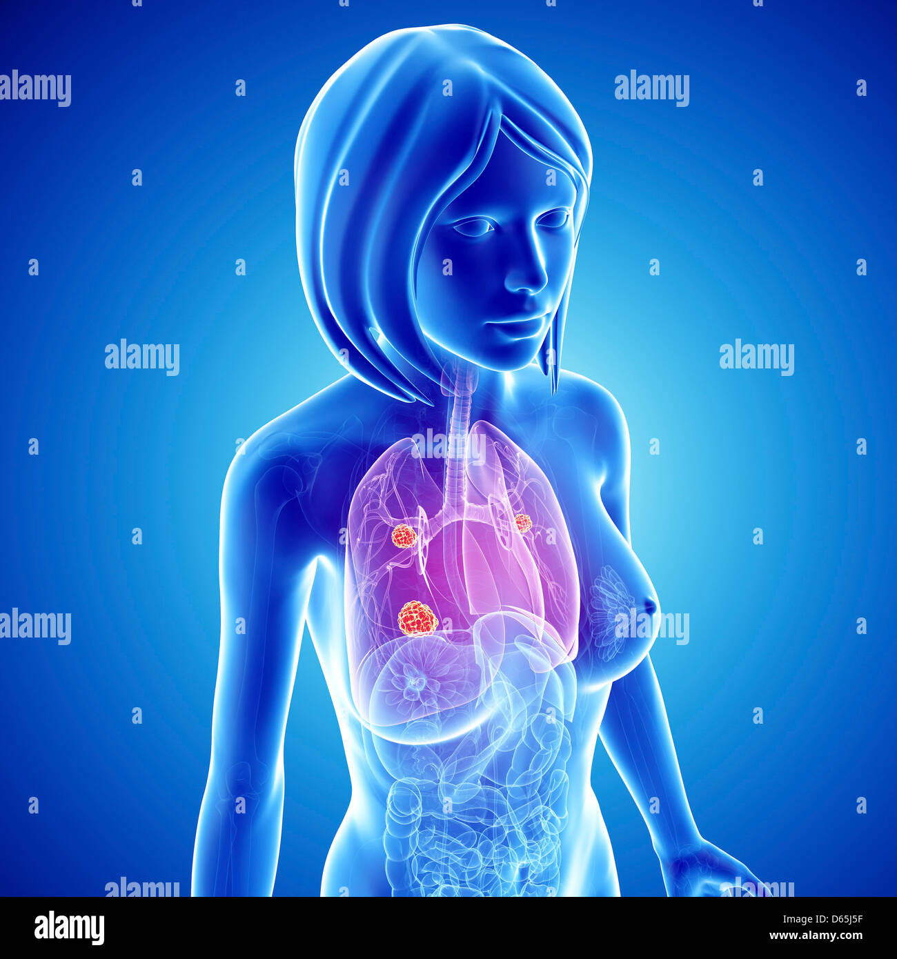 Femmina di cancro ai polmoni, artwork Foto Stock