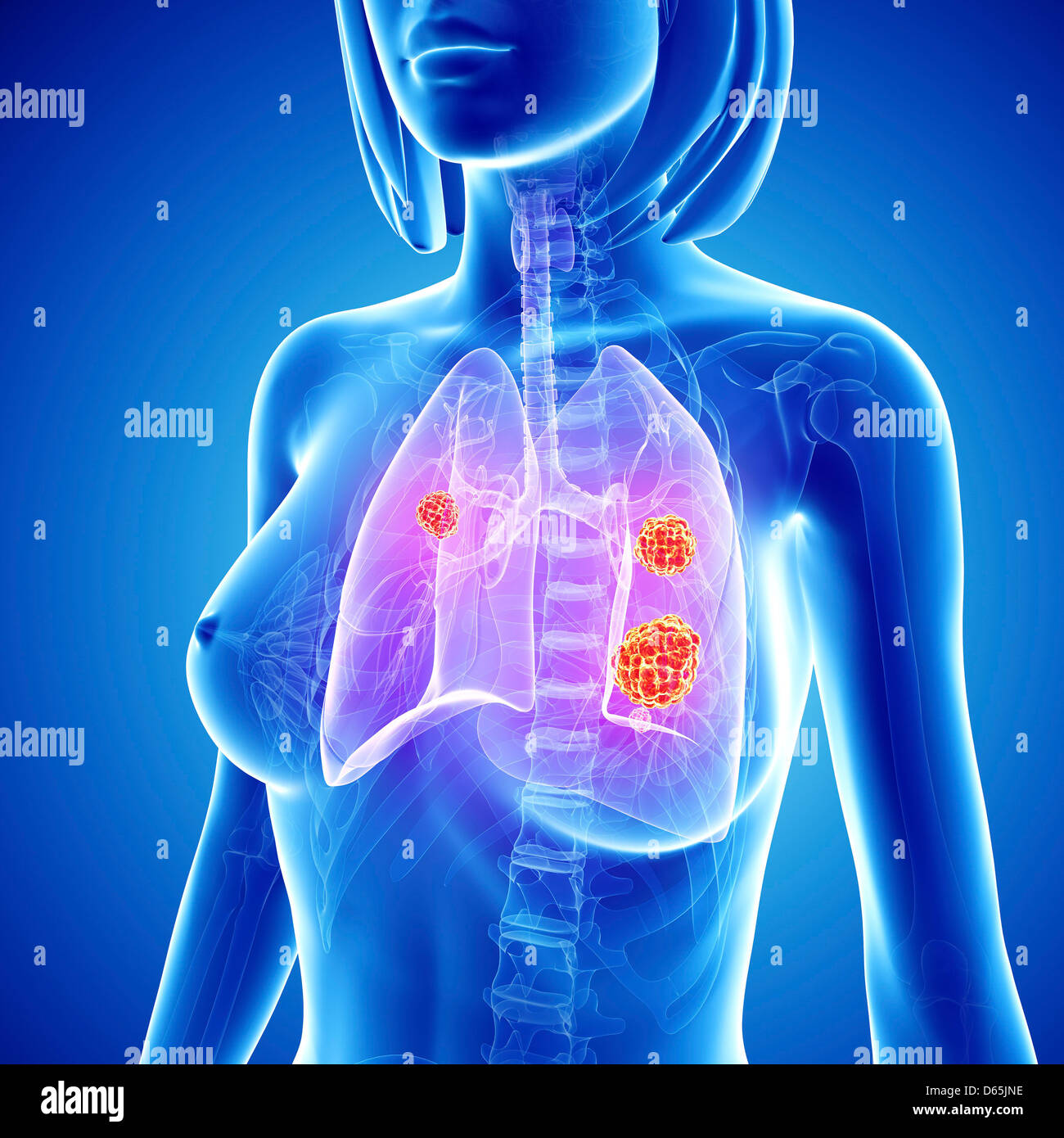 Femmina di cancro ai polmoni, artwork Foto Stock