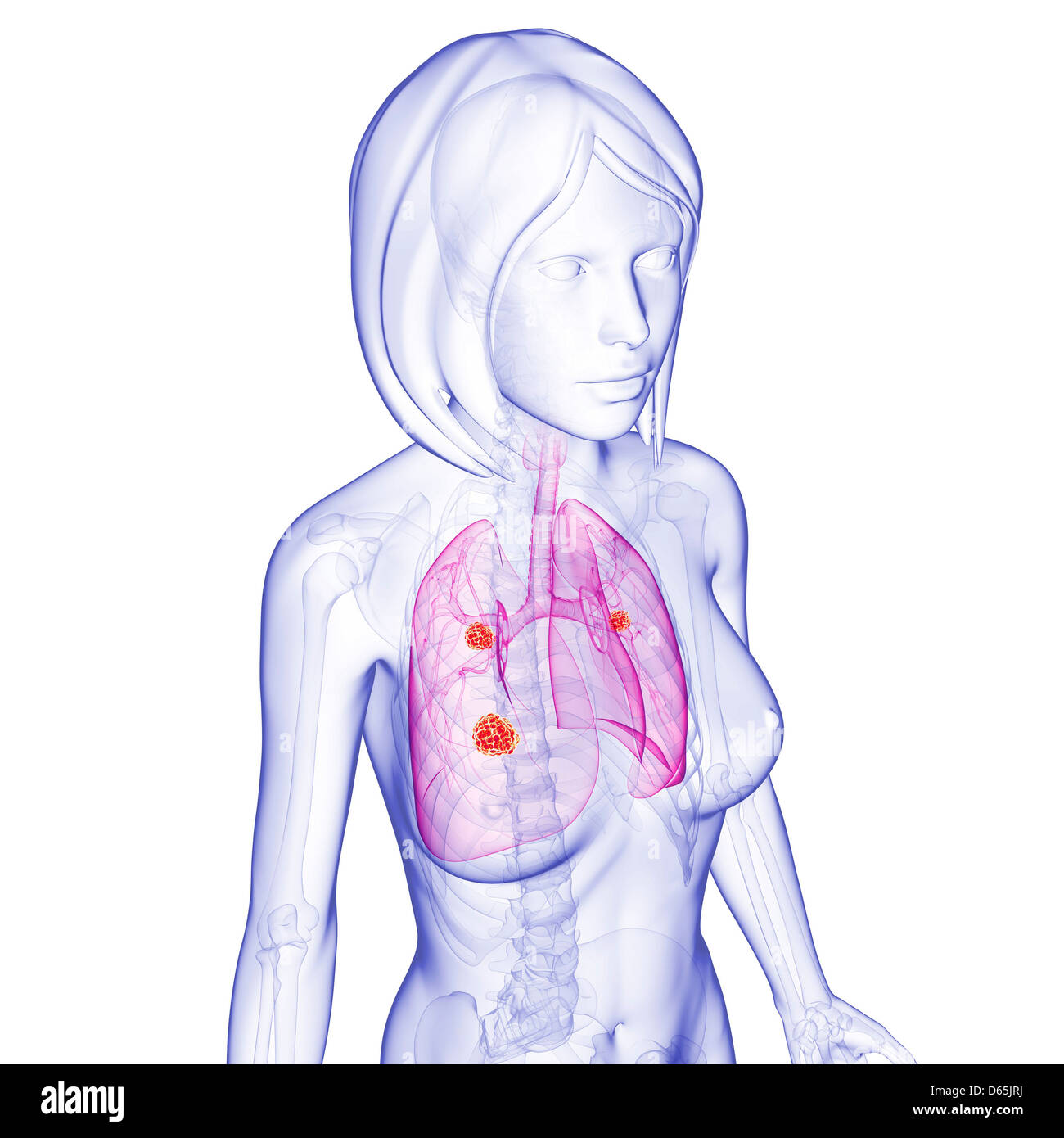 Femmina di cancro ai polmoni, artwork Foto Stock