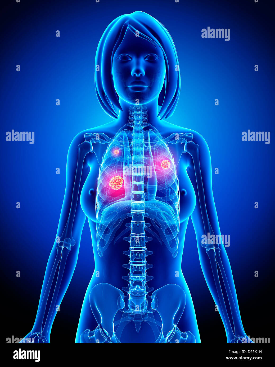 Femmina di cancro ai polmoni, artwork Foto Stock