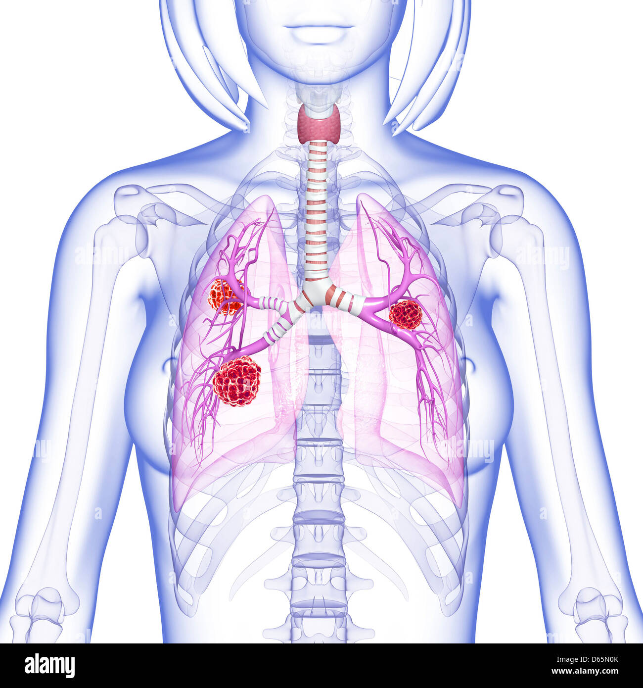 Femmina di cancro ai polmoni, artwork Foto Stock
