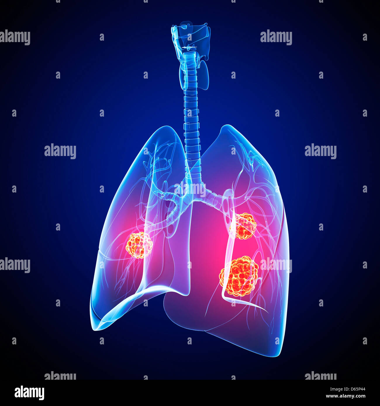 Il cancro del polmone, artwork Foto Stock