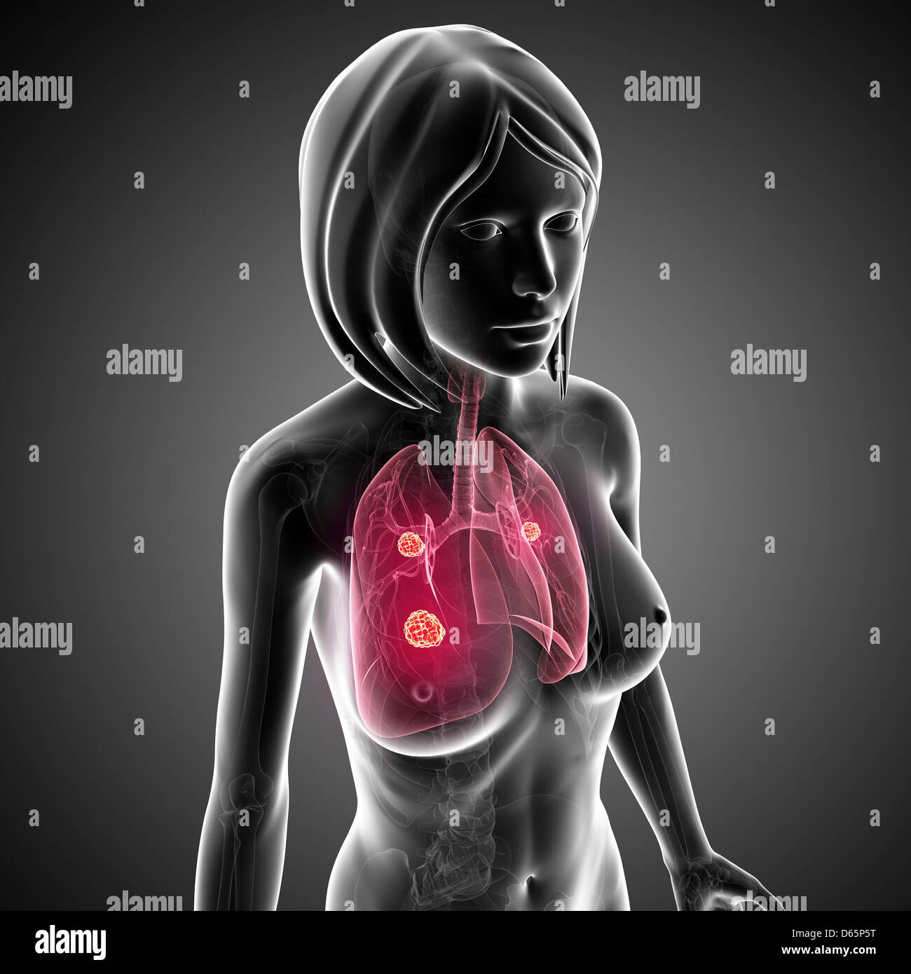 Femmina di cancro ai polmoni, artwork Foto Stock