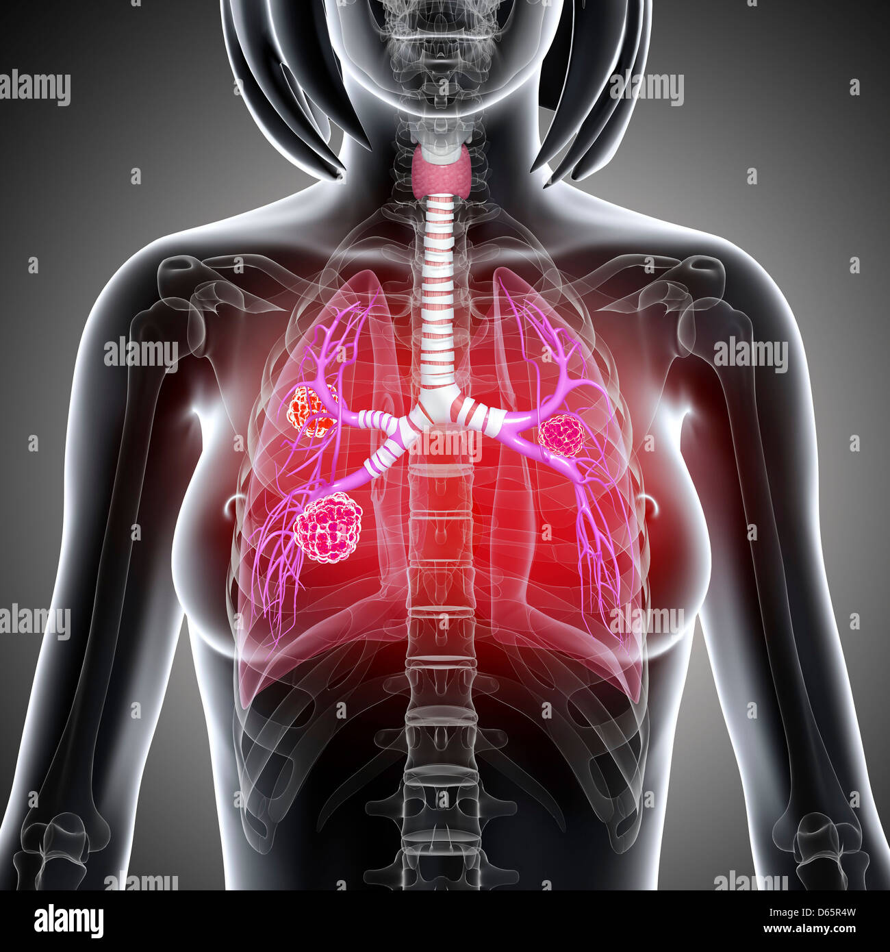 Femmina di cancro ai polmoni, artwork Foto Stock