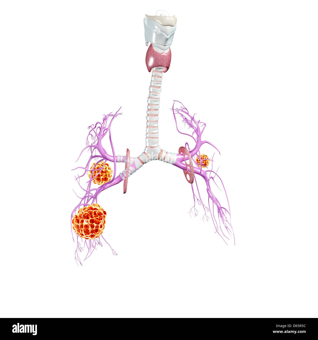 Il cancro del polmone, artwork Foto Stock