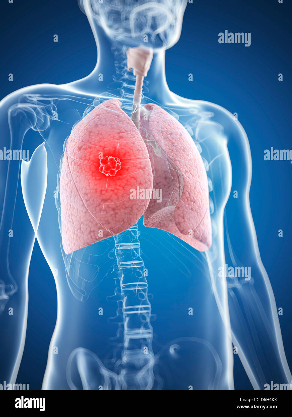 Il cancro del polmone, artwork Foto Stock