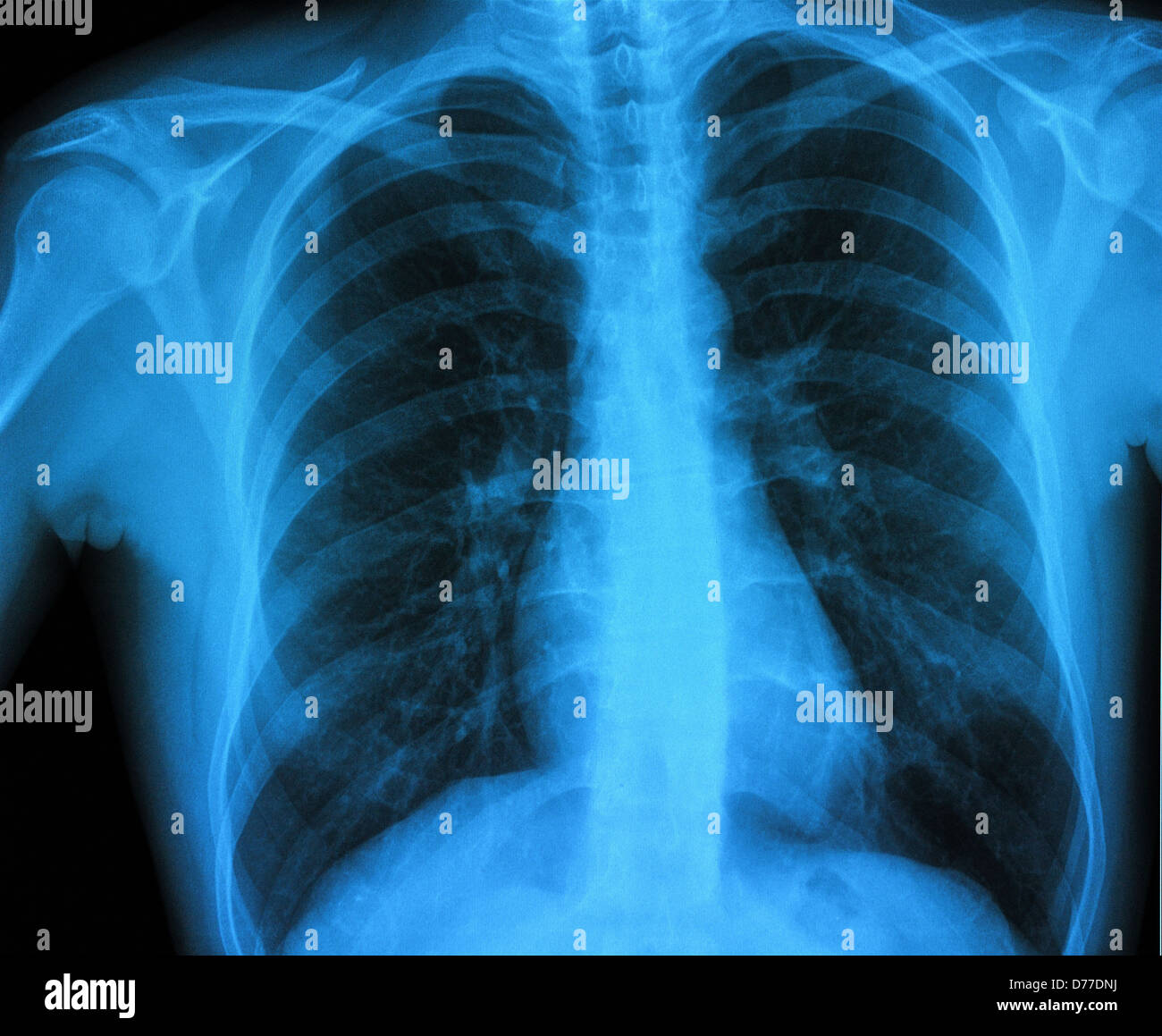 Immagine a raggi X al torace sano Foto Stock
