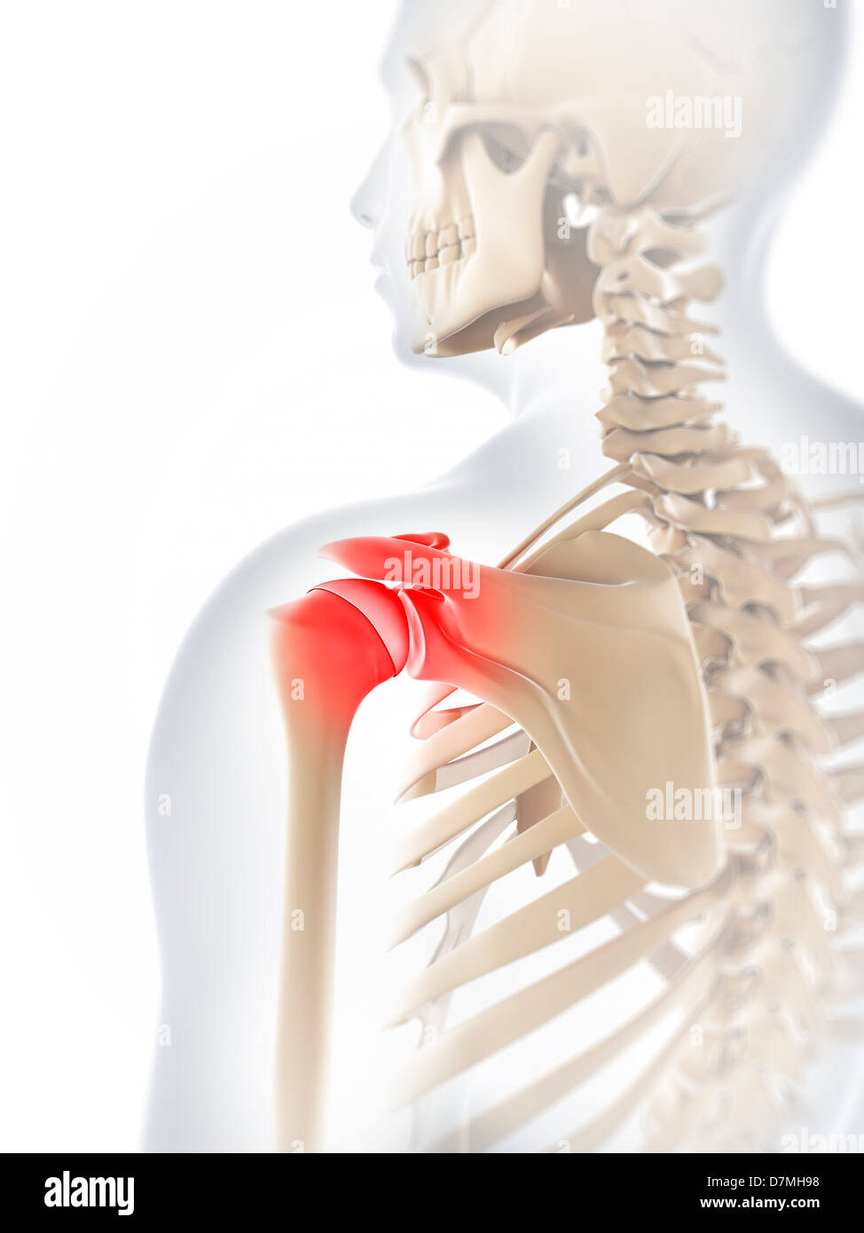 Dolore alla spalla, opere d'arte concettuale Foto Stock