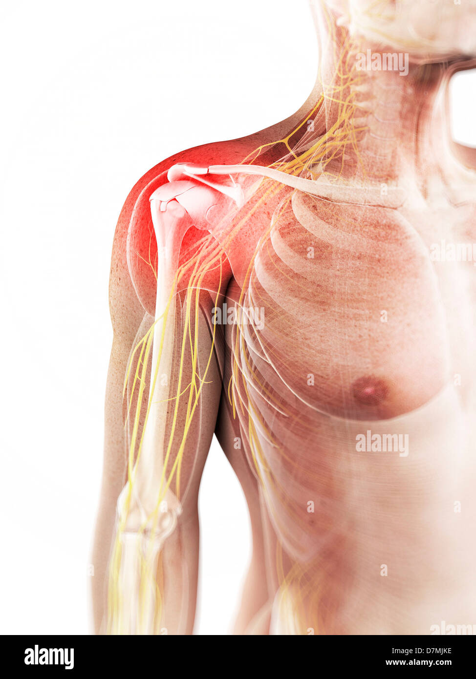 Dolore alla spalla, opere d'arte concettuale Foto Stock