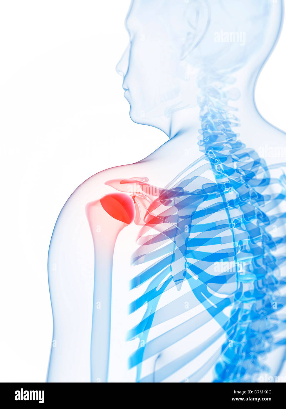 Dolore alla spalla, opere d'arte concettuale Foto Stock