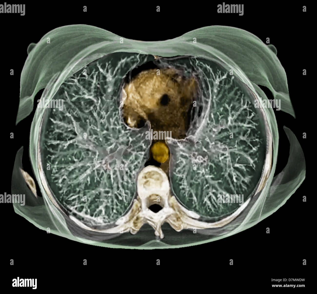 Anatomia del torace, 3D CT scan Foto Stock