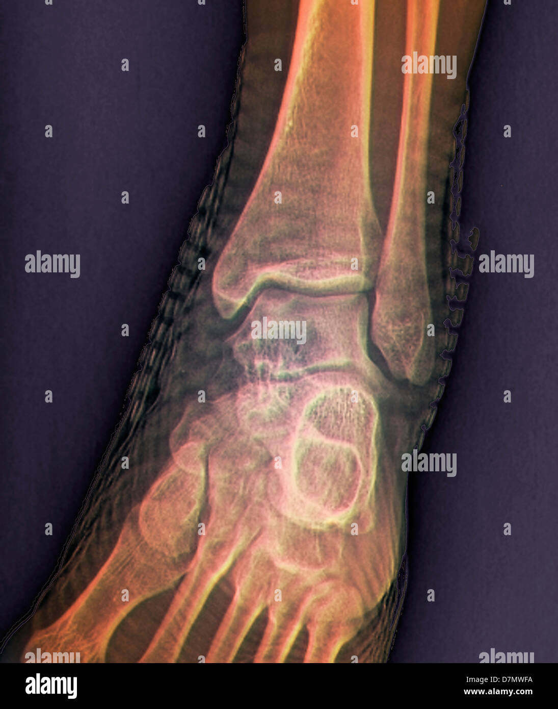 Una sana della caviglia, X-ray Foto Stock