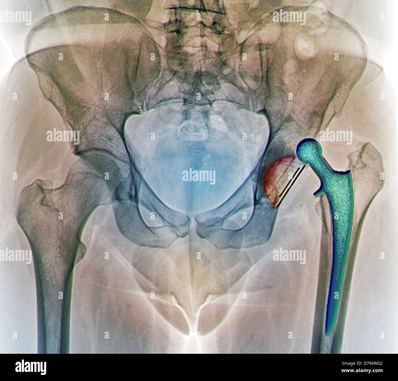 Dislocato anca, X-ray Foto Stock