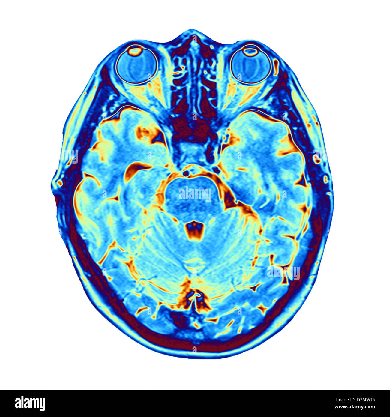 Esplorazione di MRI del cervello Foto Stock