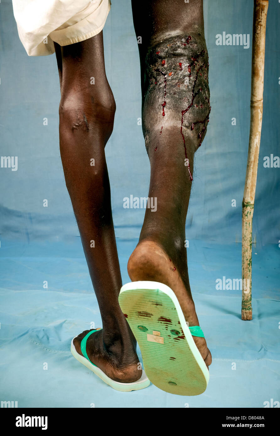 Trasudamento di sangue dai seni di 27 anni del maschio della gamba con eumycetoma sotto il ginocchio destro. Foto Stock