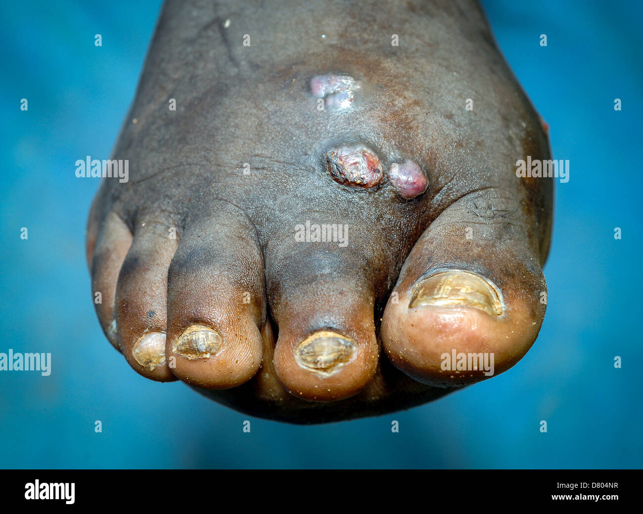 Il piede destro di un vecchio di 35 anni di sofferenza maschio da mycetoma (Madura piedi). Foto Stock