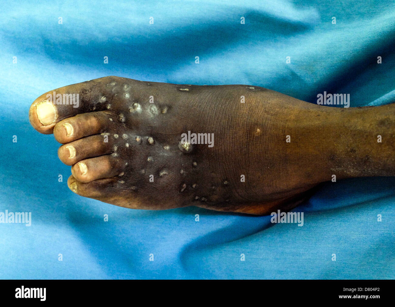 Mycetoma sul piede di un giovane maschio. Foto Stock