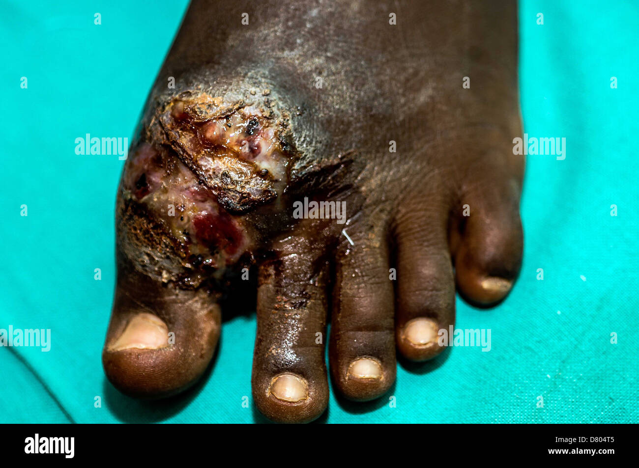 Mycetoma che colpiscono i piedi e le dita dei piedi di un giovane maschio. Foto Stock