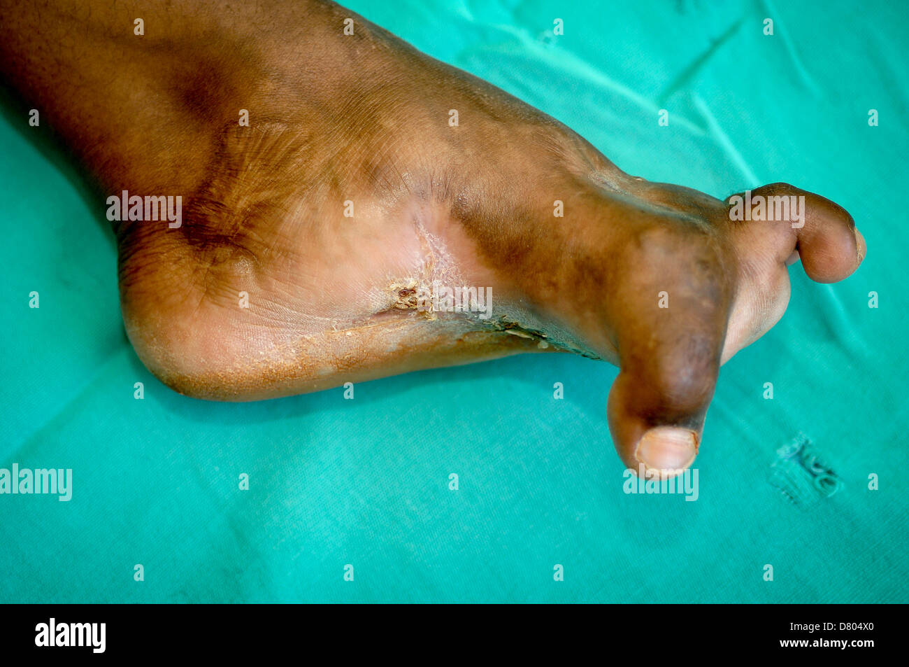 Mycetoma interessa il piede di un uomo giovane. Il mycetoma inoltre ha causato una grave deformazione delle dita. Foto Stock