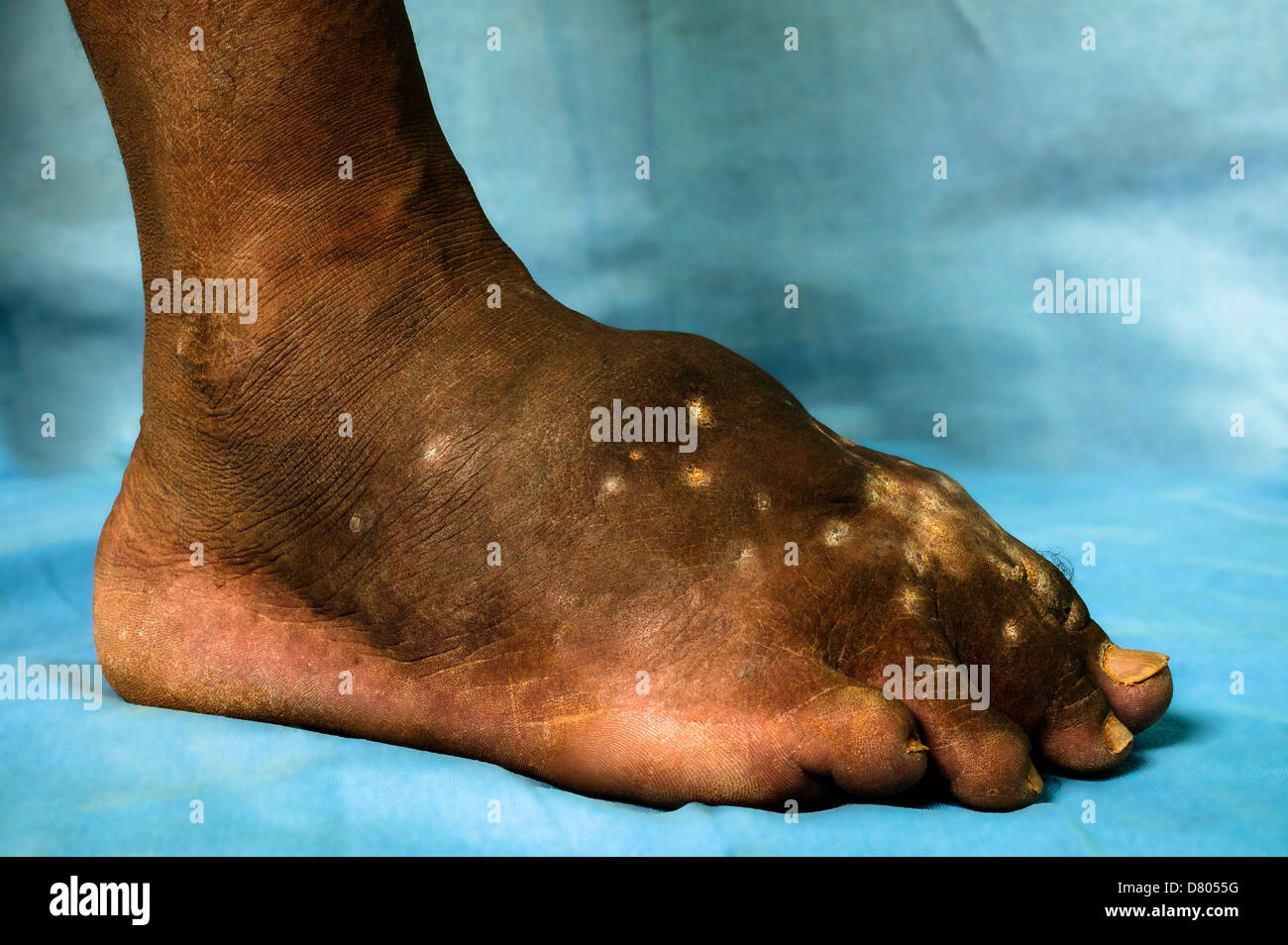 Actinomycetoma del piede sinistro. Foto Stock
