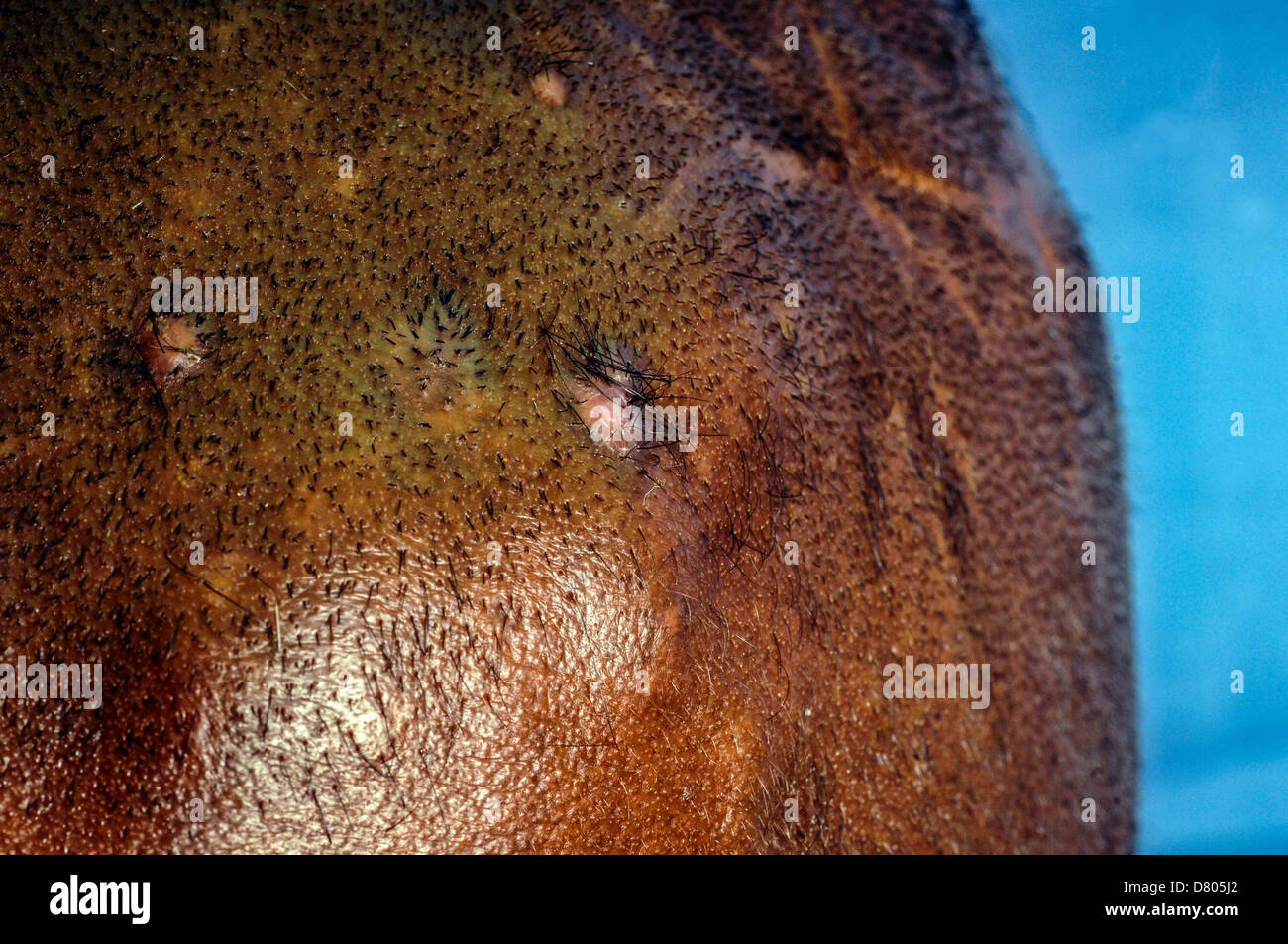 Actinomycetoma sulla testa di un 36 anni di sesso maschile. Foto Stock