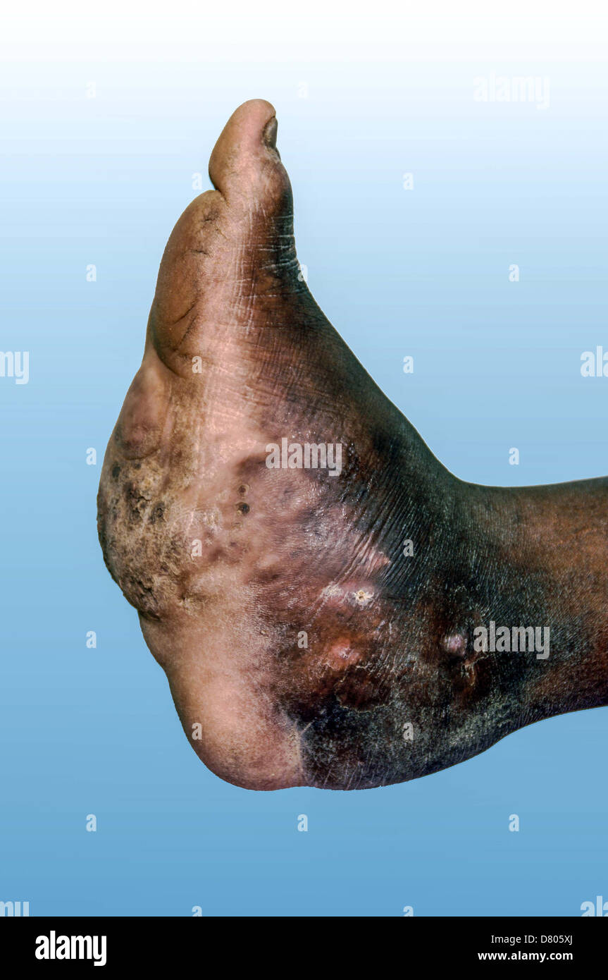 Mycetoma sul piede sinistro di un giovane maschio. Foto Stock