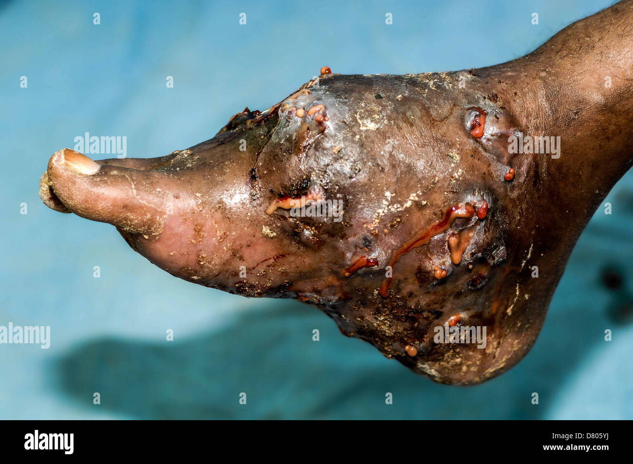 Un piede con actinomycetoma. Foto Stock