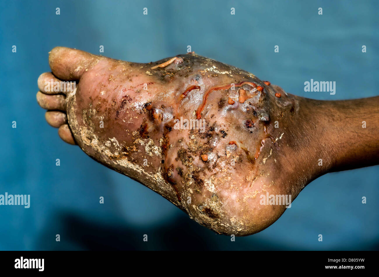 Un piede con actinomycetoma. Foto Stock