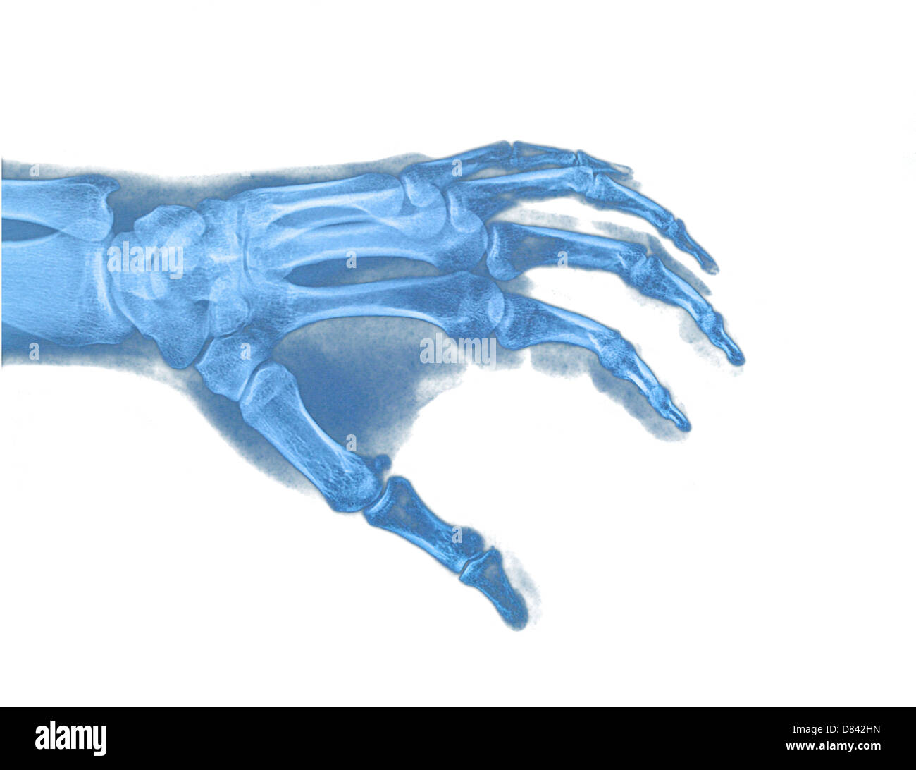 Mano xray immagine sfondo medicale Foto Stock