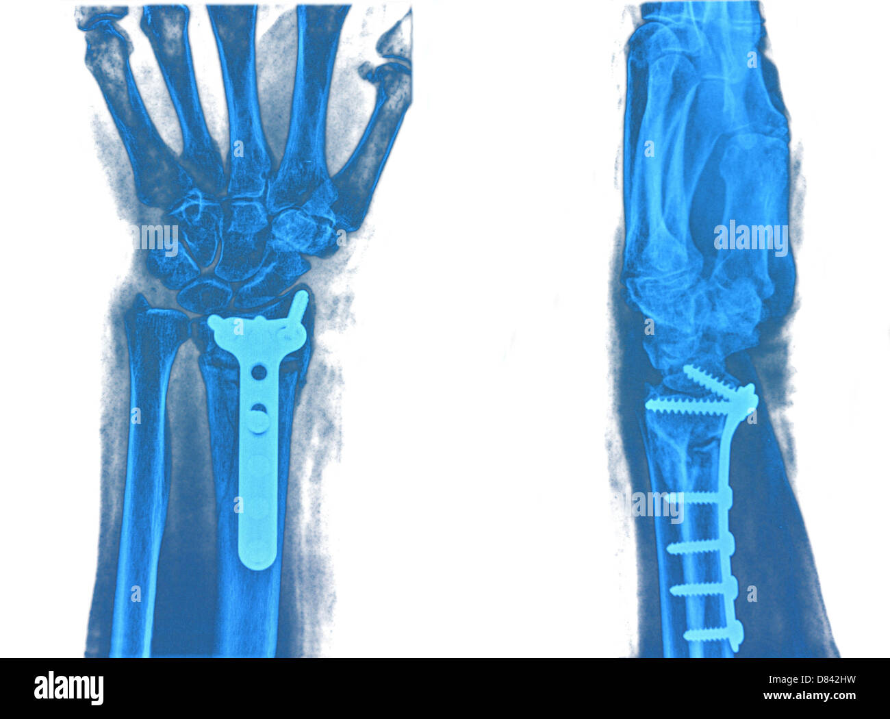Mano xray immagine sfondo medicale Foto Stock