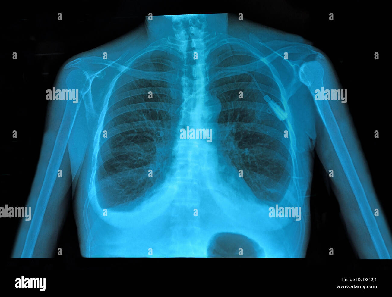 Immagine a raggi X al torace sano Foto Stock