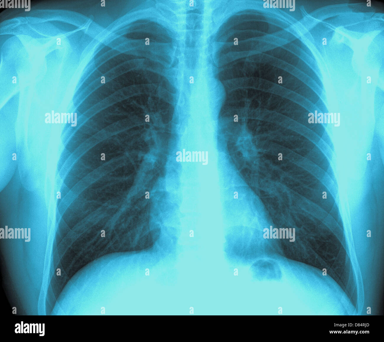 Immagine a raggi X al torace sano Foto Stock