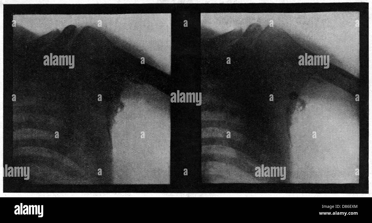 X Ray di soldati pregiudizio WW1 Foto Stock