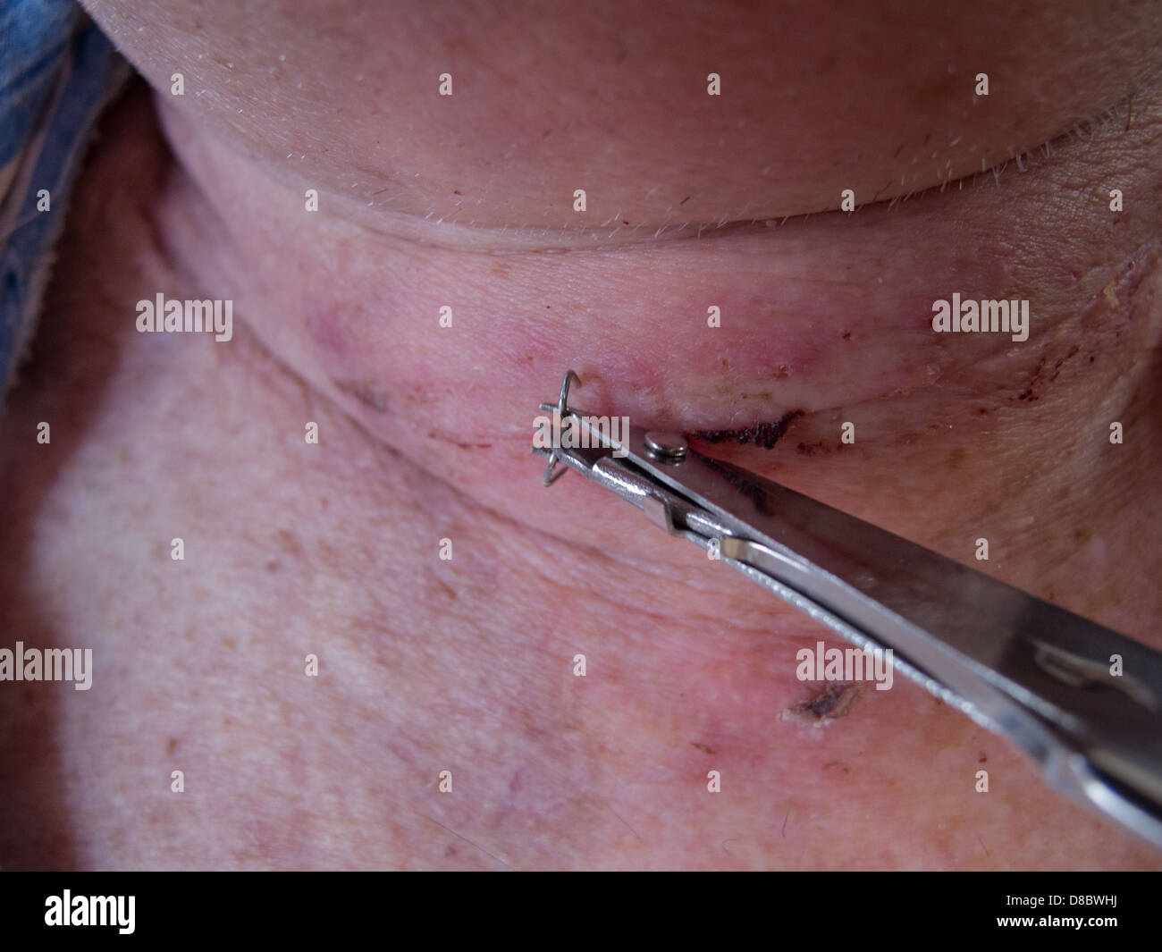 Surgical clips immagini e fotografie stock ad alta risoluzione - Alamy