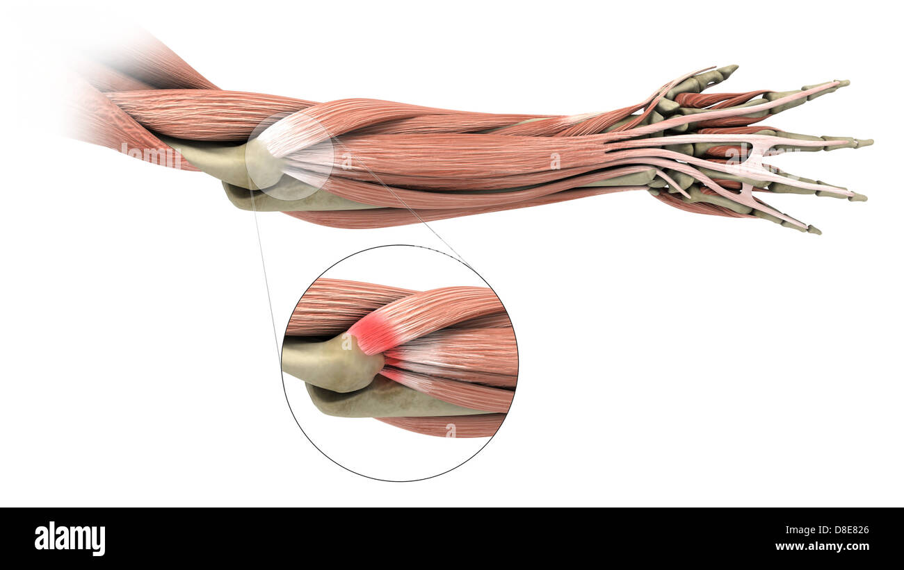 Illustrazione di un gomito del tennista (epicondilite laterale) Foto Stock