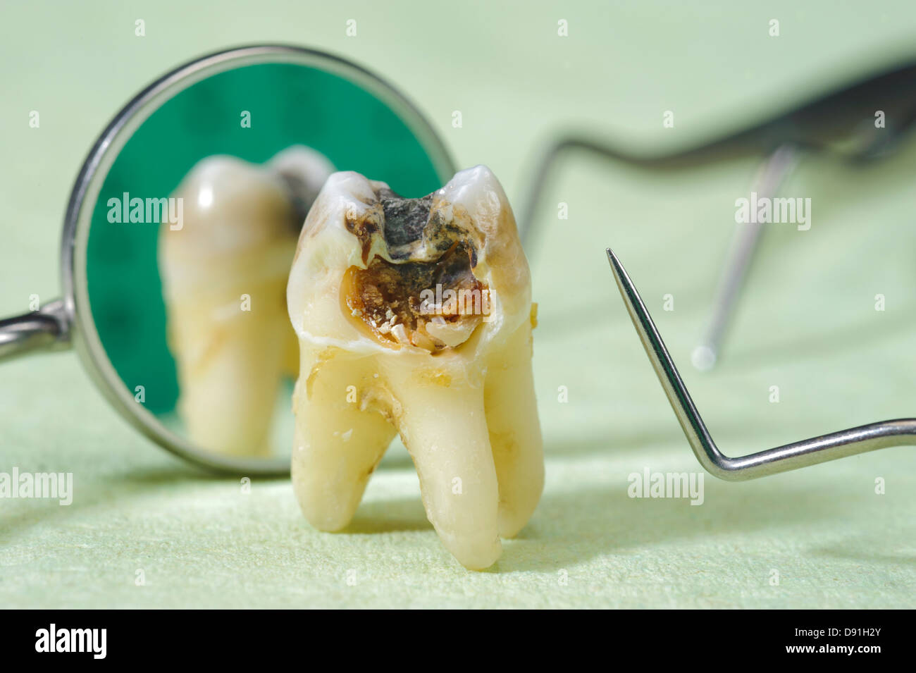 Carie dentaria immagini e fotografie stock ad alta risoluzione Alamy