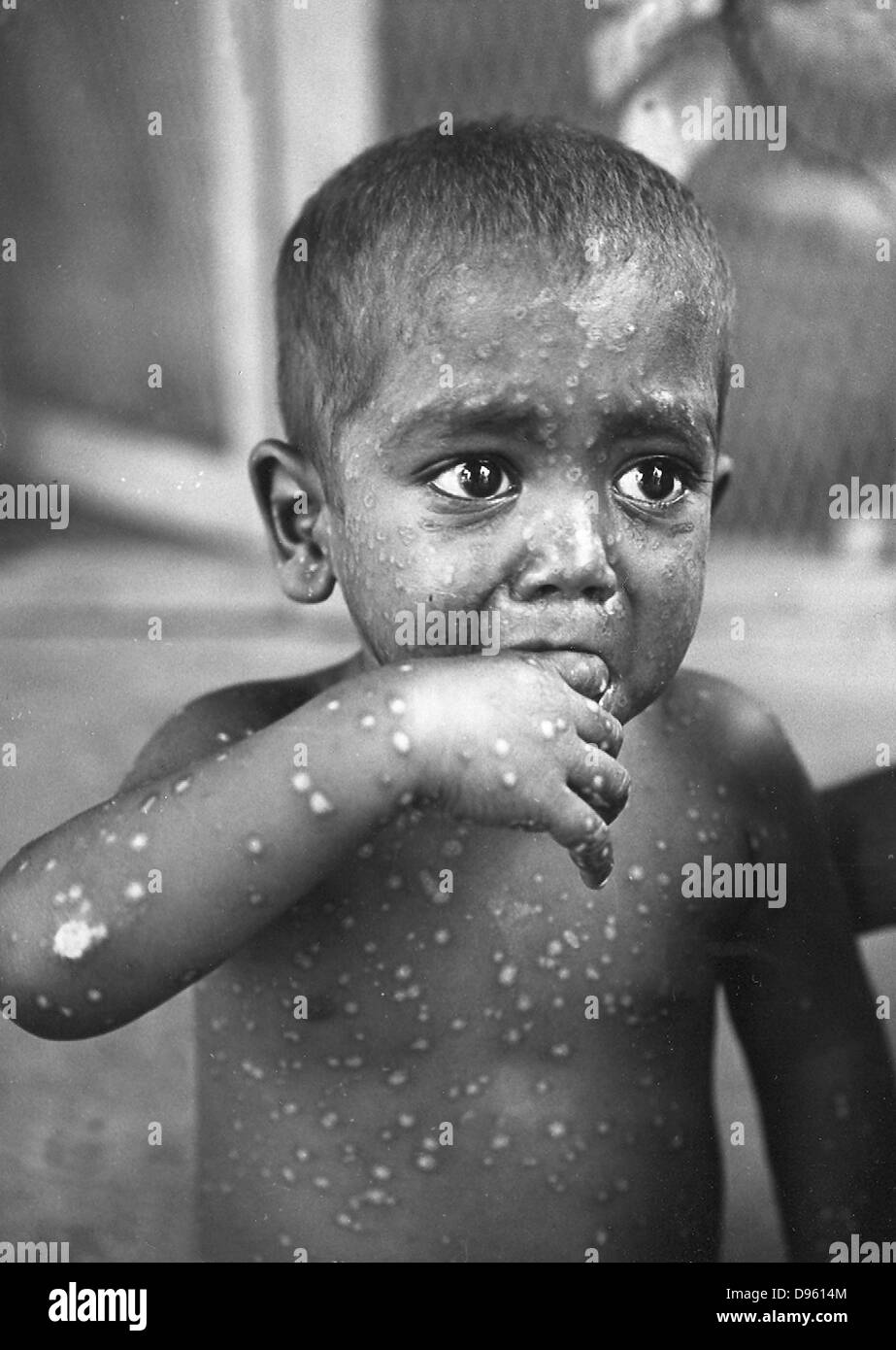 Un bambino con il virus del vaiolo, Malattie Infettive Ospedale, Madras, India, 1970s. Chi fotografia di FN Sharma. Foto Stock