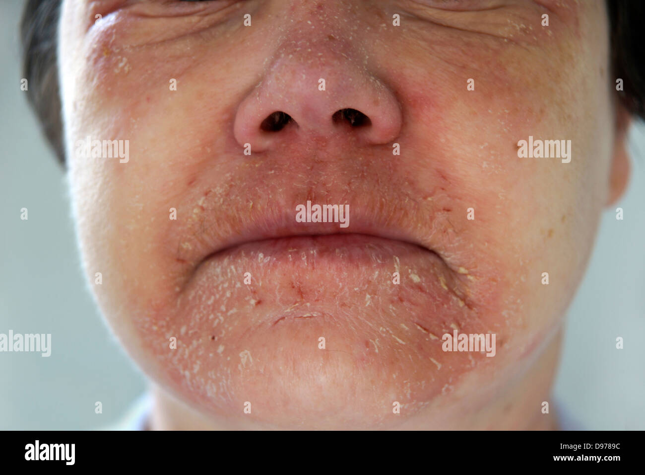 La donna la sofferenza con eczema & una eruzione cutanea che coprono la maggior parte del viso con il dolore che circonda e che interessano la zona della bocca Foto Stock