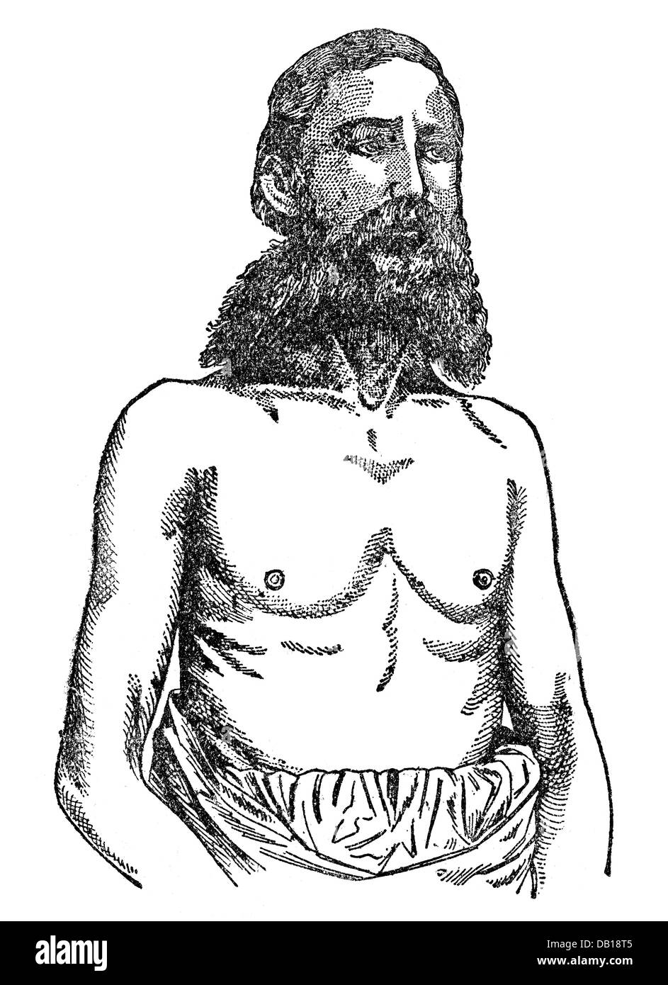 Medicina, anatomia, scheletro / ossa, torace consumptive, incisione del legno, da: Friedrich Eduard Bilz, New Naturopathic Treatment, Leipzig, Germania, 1902, Additional-Rights-Clearences-Not Available Foto Stock