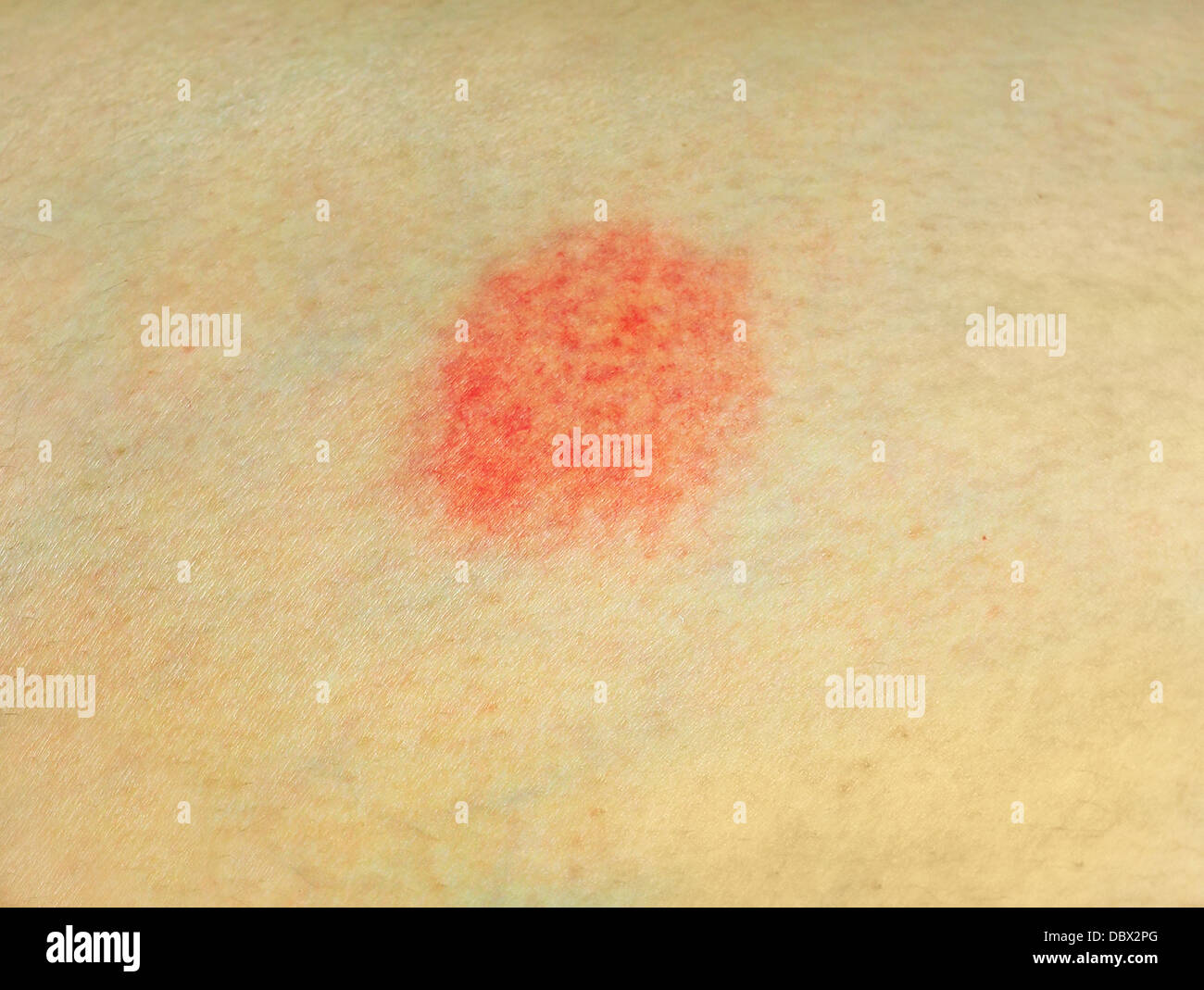 Macchia rossa sulla pelle Foto stock - Alamy