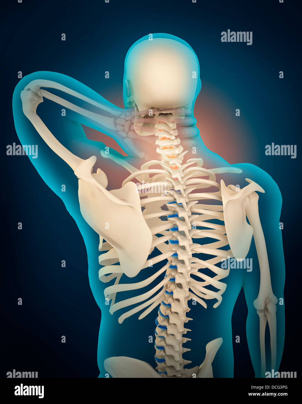Illustrazione medica mostra infiammazione e dolore umano nella zona del collo, vista prospettica. Foto Stock