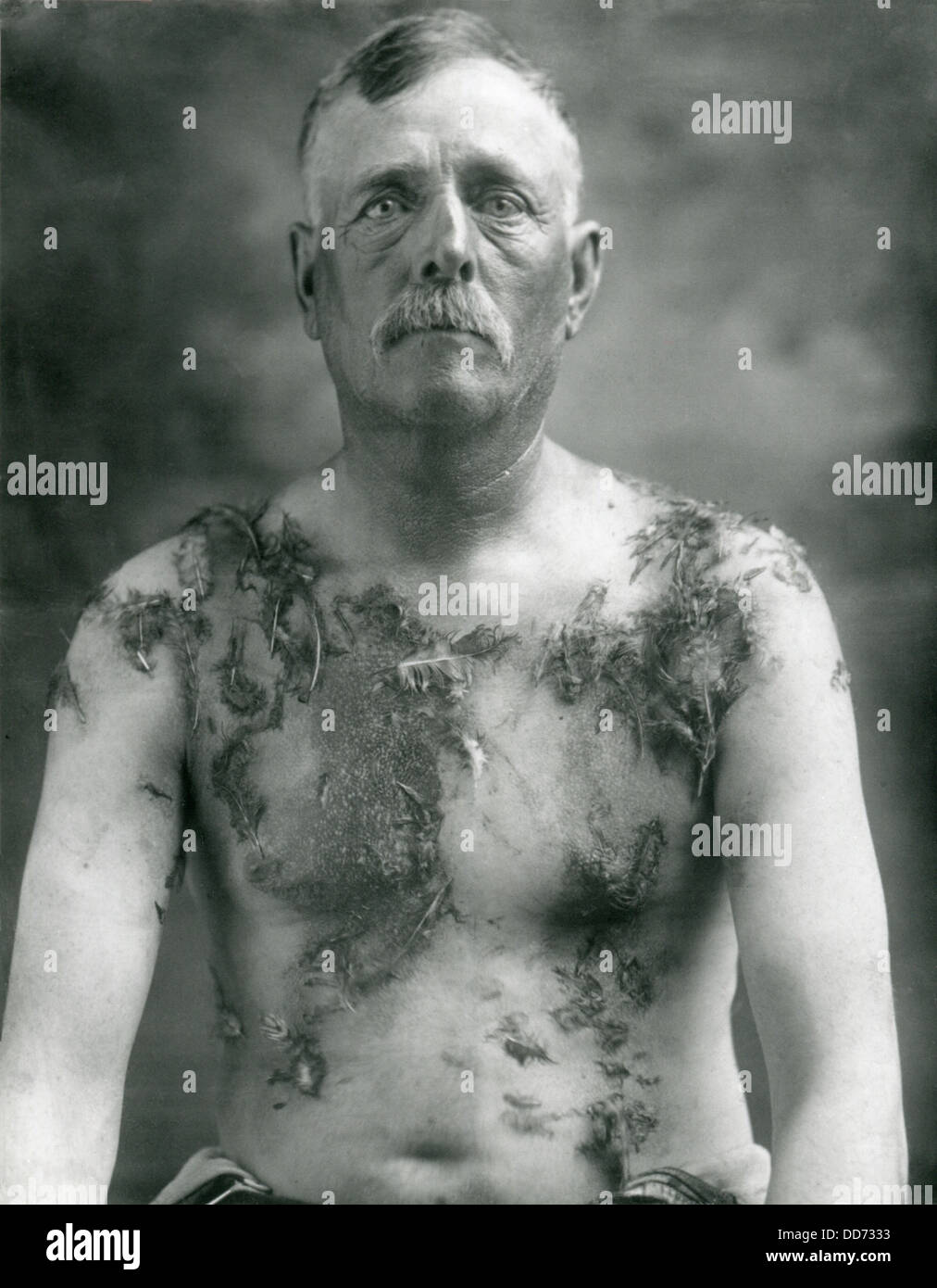 Guerra mondiale 1. John Meintz, un agricoltore tedesco-americana di Luverne, Minnesota, era asfaltata e selvaggina di penna da Anti-German vigilantes sul Foto Stock