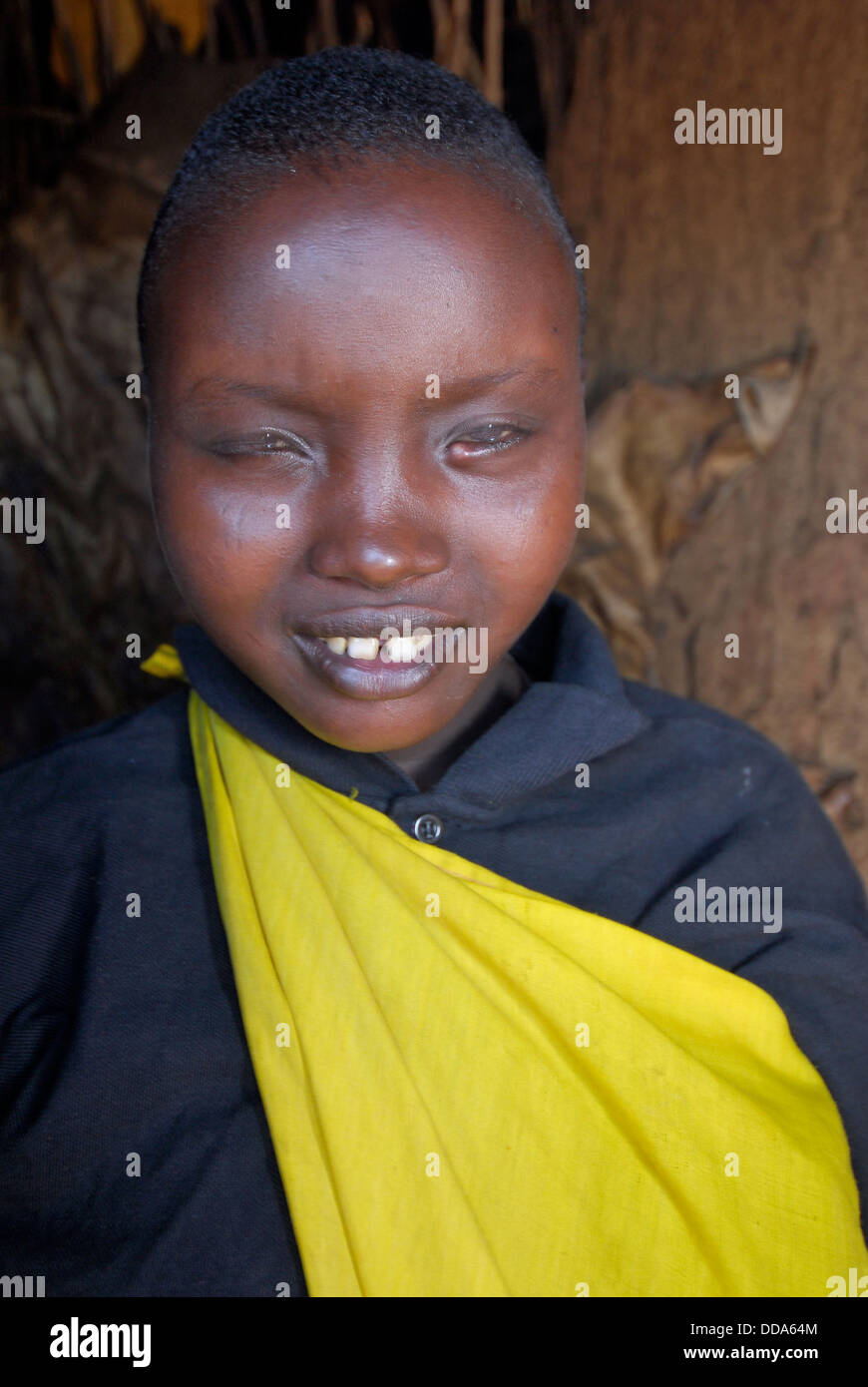 Una donna Masai con un occhio infezione, una comune affezione. Foto Stock