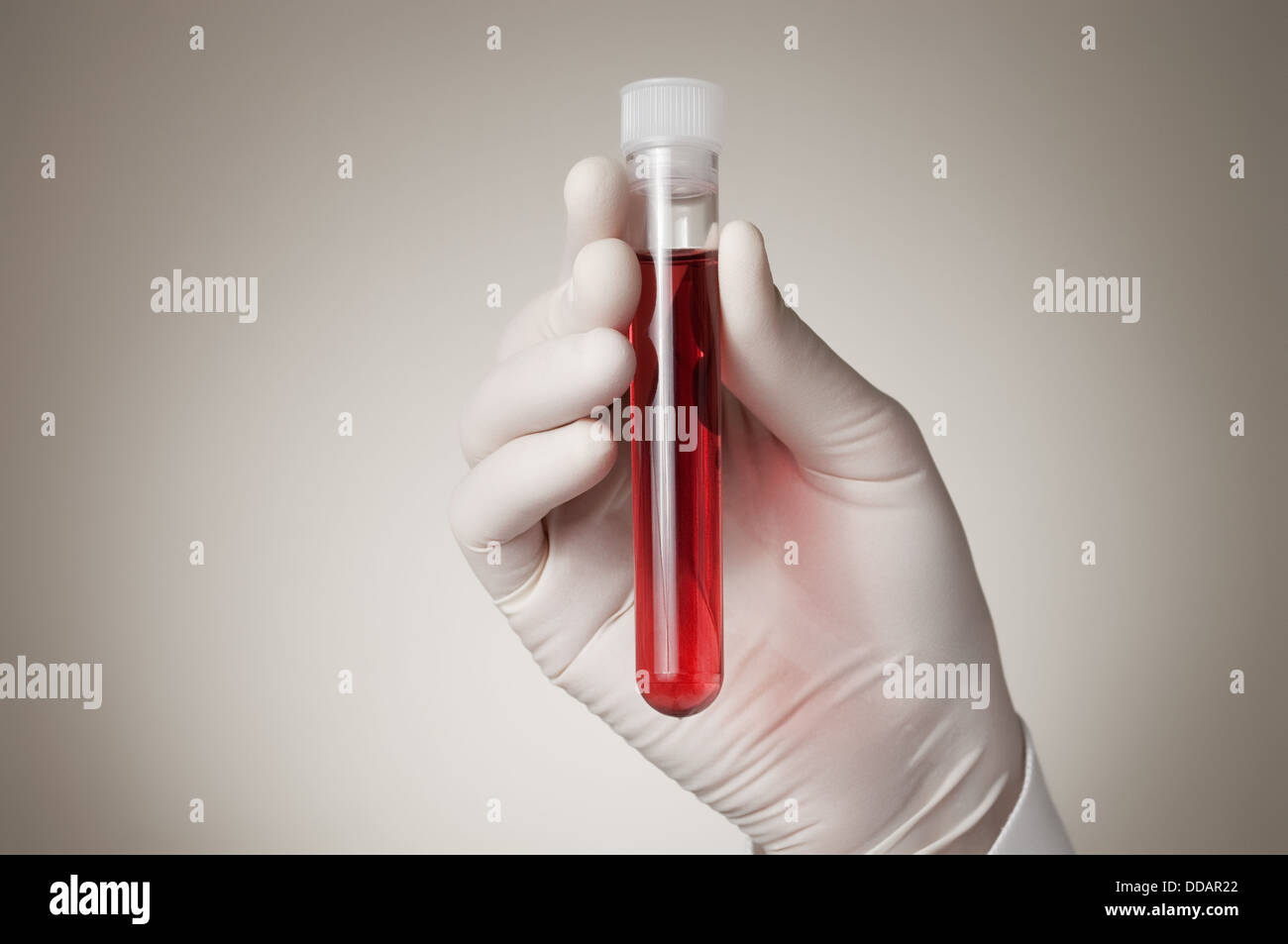 Medico la mano con il campione di sangue Foto Stock