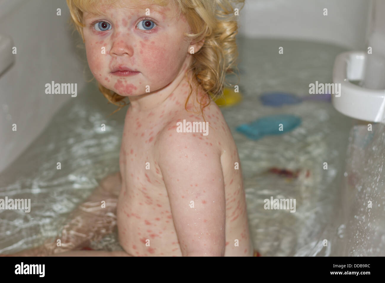 Un anno e mezzo di lavoro vecchia ragazza la sofferenza con la varicella  macchie sul suo viso e corpo - seduta nel bagno Foto stock - Alamy