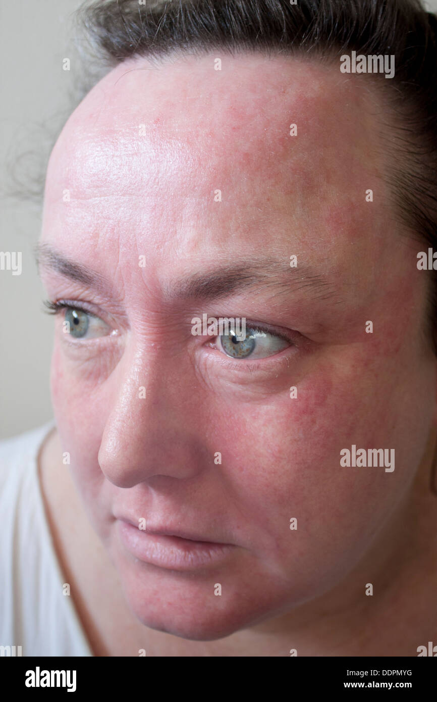 Donna con grave eczema reazione allergica sulla faccia Modello rilasciato Foto Stock