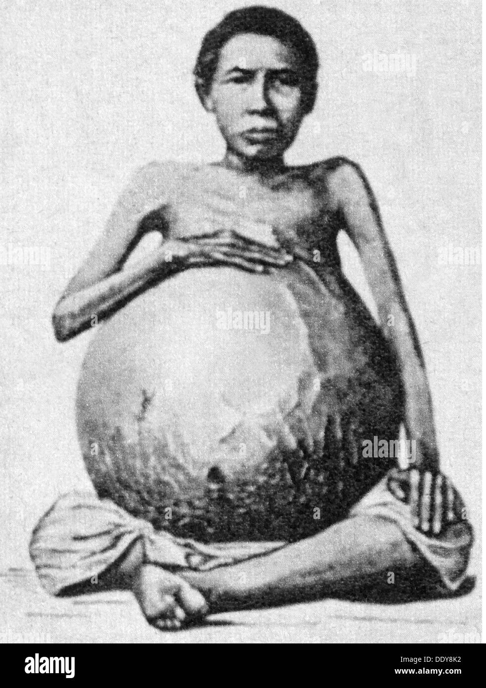 Medicina, malato, donna con pancia gonfia da una cisti ovarica, Thailandia, lunghezza intera, seduta, seduta, seduta, parte superiore del corpo, corpo superiore, striscia la vita, spogliato della vita, pancia, pancia, pancia, pancia, malessere, malattia, malattia, malattie, malattie, medicina, medicine, malato, malato, donna, vita storica, Storico, donna, donna, donna, donna, persone, diritti aggiuntivi-clearences-non disponibile Foto Stock