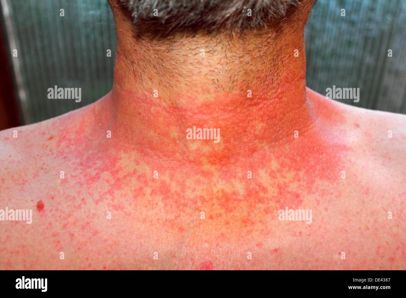 Dermititis dovrebbe essere dermatitisRed rash cutaneo su un uomo il collo e  il torace a causa di scarlattina, febbre, dermatite o eczema Foto stock -  Alamy