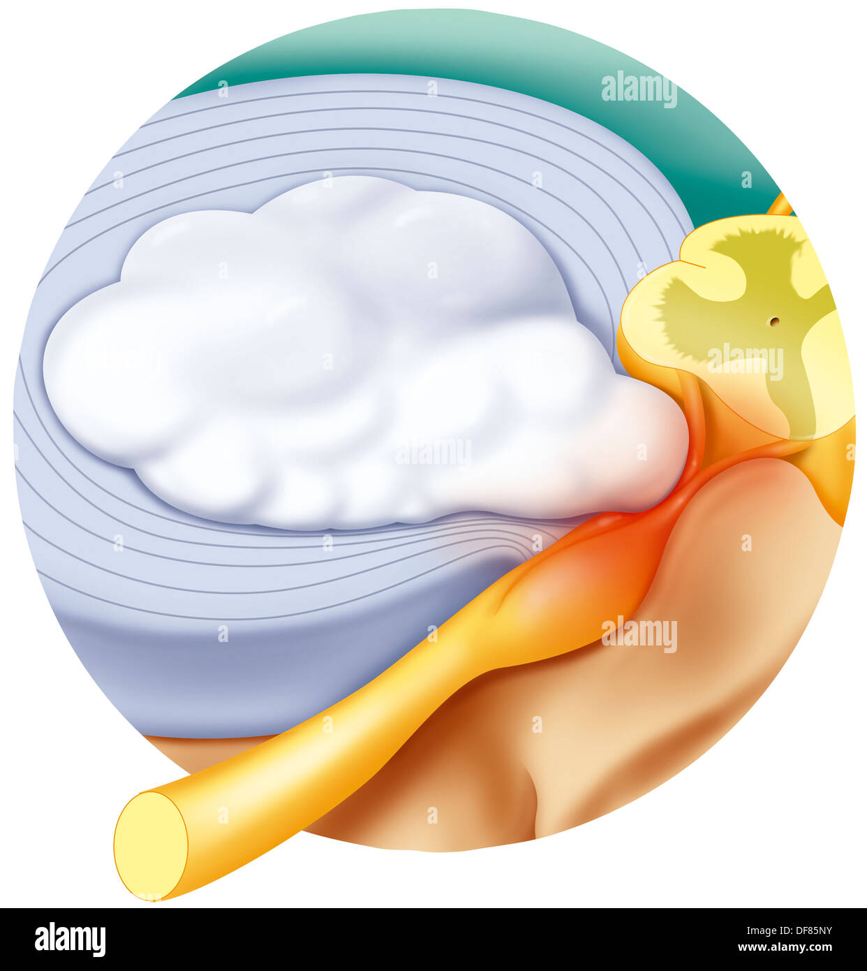 Ernia del disco, illustrazione Foto Stock