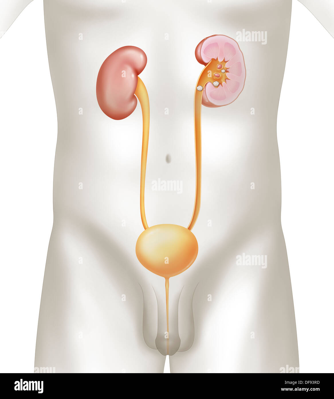 Litiasi renale disegno Foto Stock